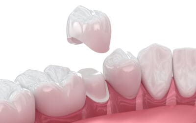 Times Dentists Recommend Dental Crowns