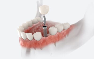 The Timeline for Getting a Dental Implant